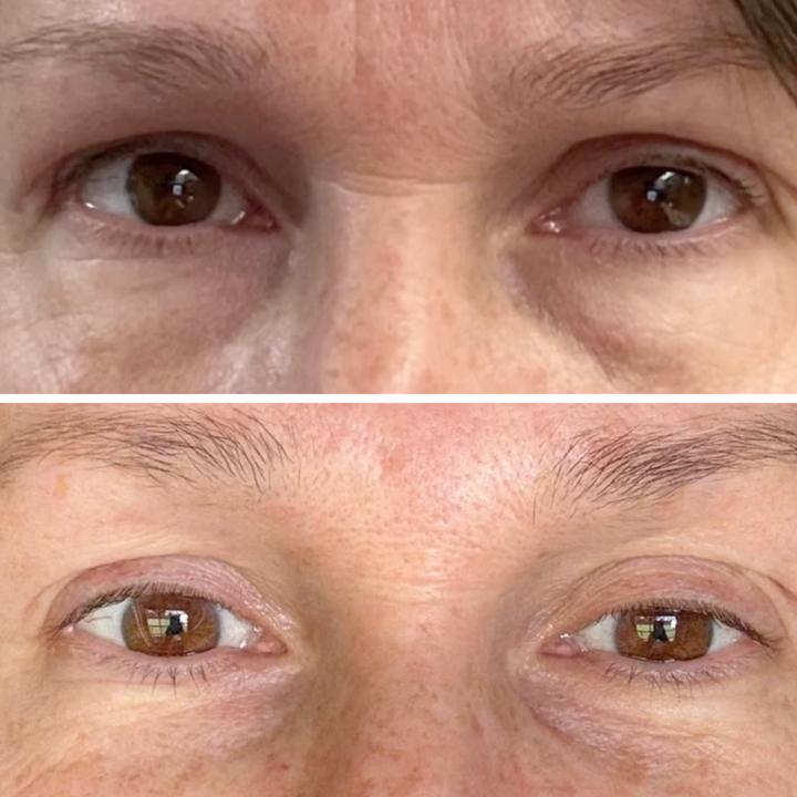Real woman, under-eye area in soft natural light