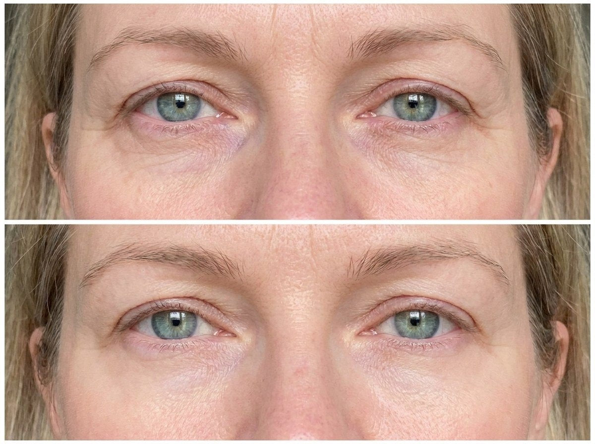 Shirley's eyes before and 45 minutes after the mask