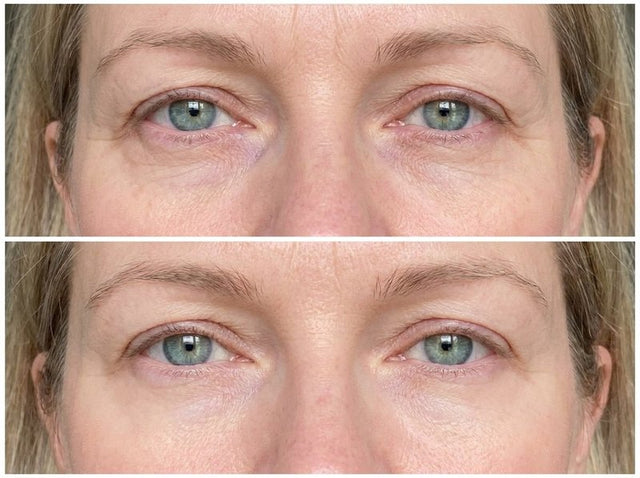 Shirley's eyes before and after the mask